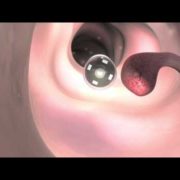 vastagbéldaganat prevenció
